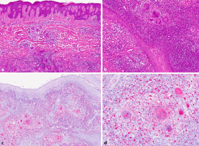 [Histological and clinical overlap of hidradenitis suppurativa and Crohn disease under IL-17 inhibition].