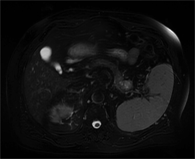 Delayed pancreatic metastasis from renal cell carcinoma managed with pazopanib and stereotactic ablative body radiotherapy.