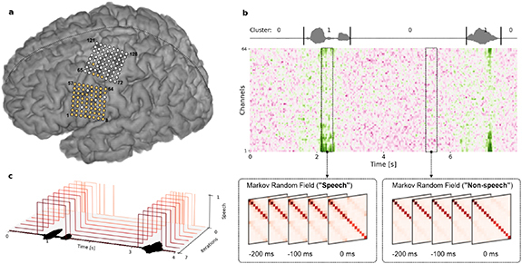 Real-time detection of spoken speech from unlabeled ECoG signals: a pilot study with an ALS participant.
