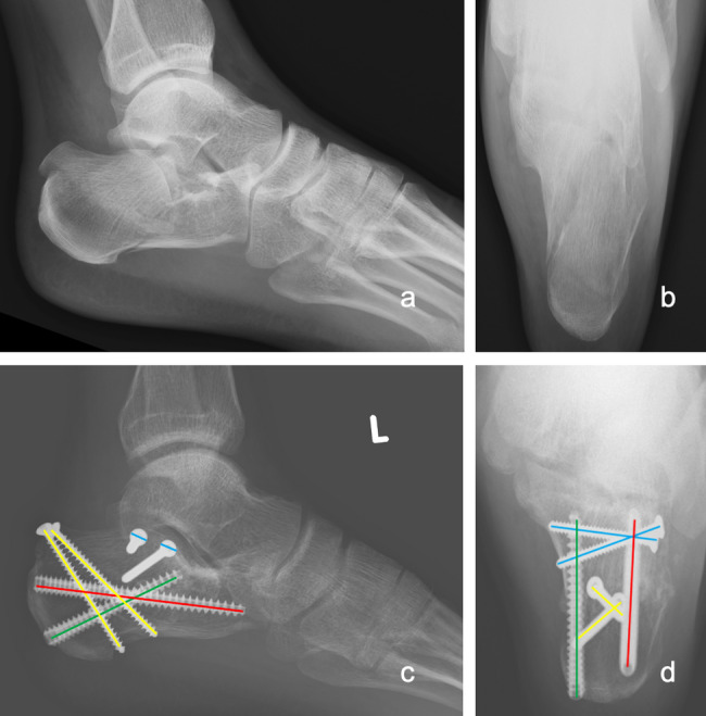 Clinical and radiologic outcomes of minimally invasive locking plate versus screw fixation for displaced intra-articular calcaneal fractures (DIACFs) via sinus tarsi approach: a comparative study.