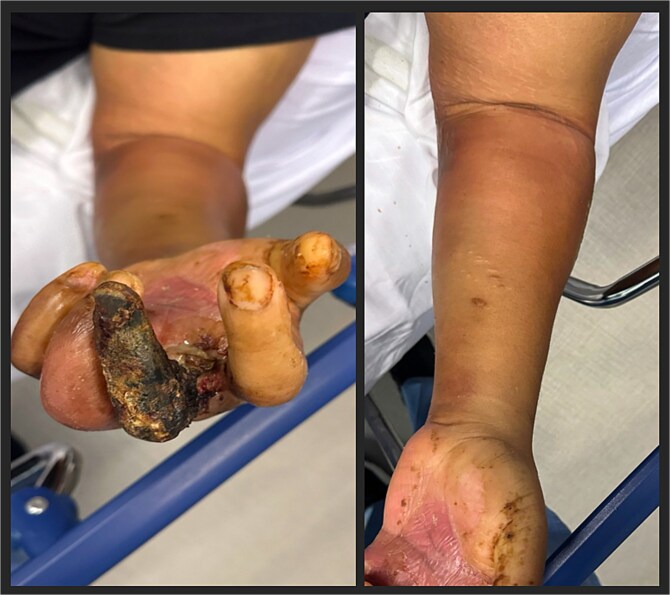 Monomicrobial necrotizing soft tissue infection of upper extremity caused by <i>Eggerthia catenaformis</i>.