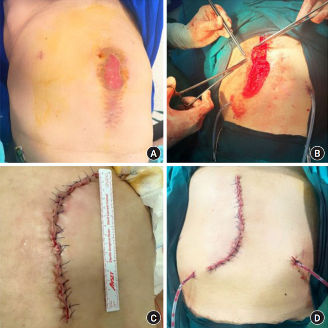Comment on "Evaluation of the efficacy of M-TAPA and EXORA block application for analgesia after laparoscopic cholecystectomy: a prospective, single-blind, observational study".