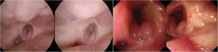 Significance of the use of a laryngotracheal flap to reconstruct defects and manage pharyngoesophageal stenosis after the resection of hypopharyngeal carcinoma with cervical oesophagus involvement: a retrospective study.