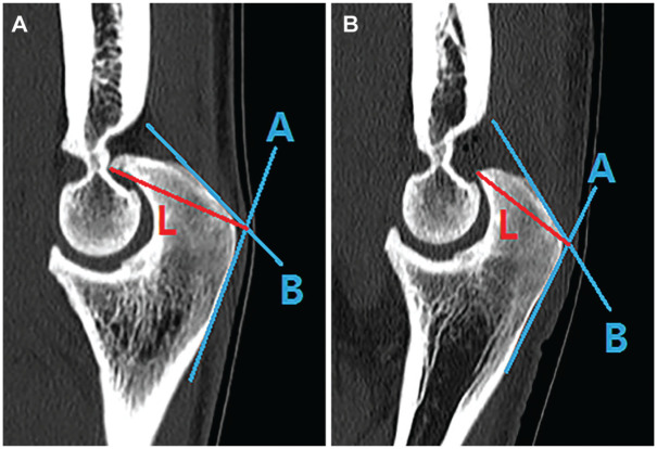Time to Return to Play After Arthroscopic Elbow Osteocapsular Arthroplasty in Professional and Elite Baseball Players.
