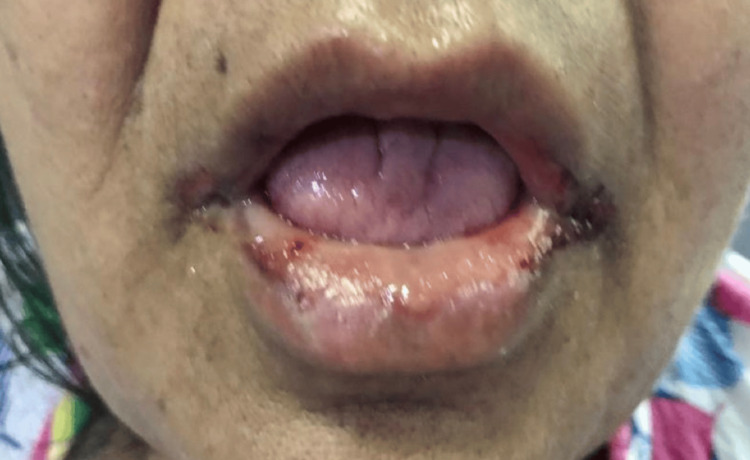 Unmasking the Masked: A Case Report of Atypical Methotrexate Toxicity Leading to Severe Bone Marrow Suppression.