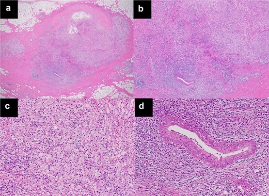 Regressed anterior mediastinal nodule secondary to removal of dental crowns.
