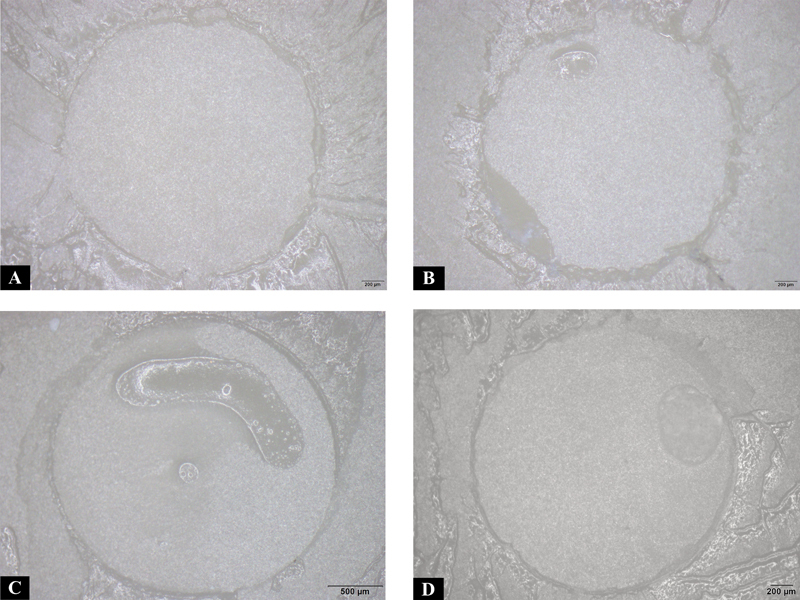 The Effect of Cement Thickness on Shear Bond Strength of Zirconia with Three Different Self-Adhesive Resin Cements.