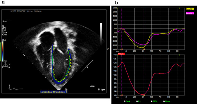 Evaluation of Cardiac Function in Children Undergoing Liver Transplantation.