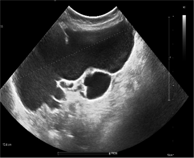 Laparoscopic management of giant abdominal cystic lymphangiomas: experience from the queen Fabiola children's university hospital.