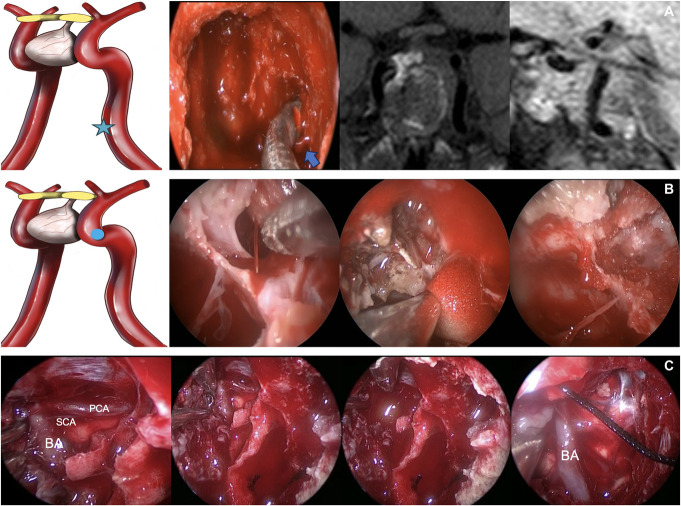 Management of Major Arterial Injuries: A Critical Complication of Endoscopic Endonasal Surgery.