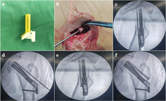3D-printed navigation-guided FNS-CCS fixation reduces complications in young adults with comminuted femoral neck fractures: a retrospective cohort study.