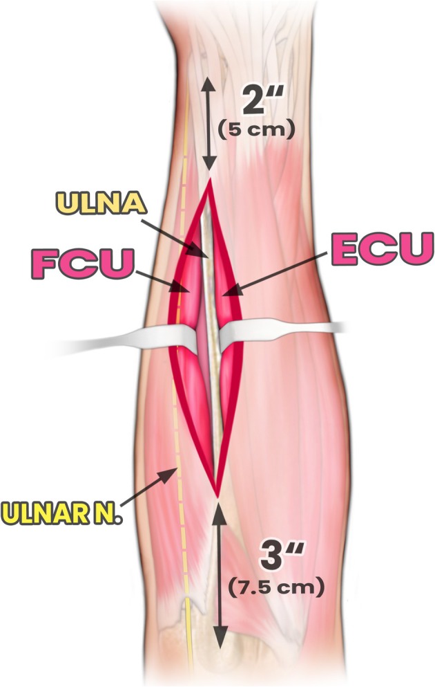 Trans-Ulnar Single Incision Fasciotomy for Decompression of Forearm Compartment Syndrome: A Cadaveric Study.