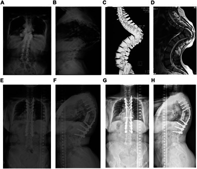 Risk Factors for Neurological Complications in Severe Spinal Deformity Surgery.