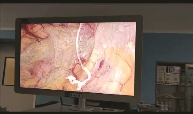 A case report of inguinal hernia combined with sparganum infestation.