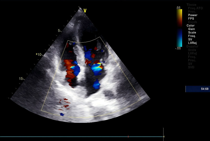 Amyloid cardiomyopathy presenting with gastrointestinal symptoms of abdominal pain, back pain, and constipation: A case report.