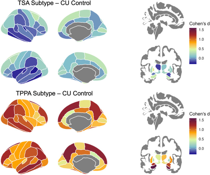 Dissecting real-world memory clinical cohort heterogeneity: analysis of neuroanatomical subtypes using HYDRA.