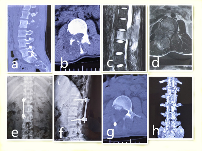 One-stage posterior surgical treatment of the rare thoracolumbar spine process and laminar nucleus with incomplete paralysis: a retrospective study.
