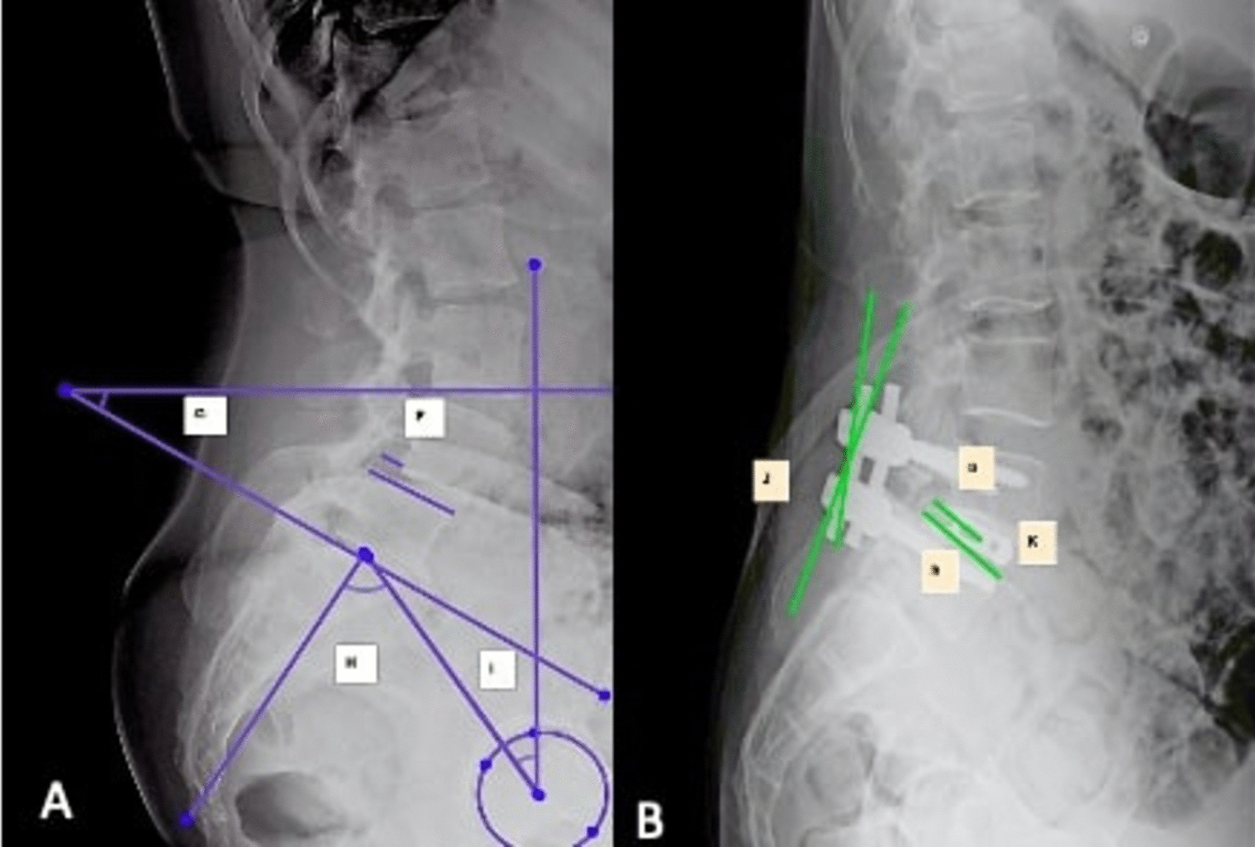 Radiographic and surgical predictive factors for restoring segmental lumbar lordosis and normal spinopelvic balance following TLIF surgery in lumbar spondylolisthesis patients.