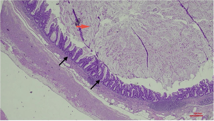An Uncommon Confluence: Splenic Lymphangioma and Appendiceal Mucinous Neoplasm.