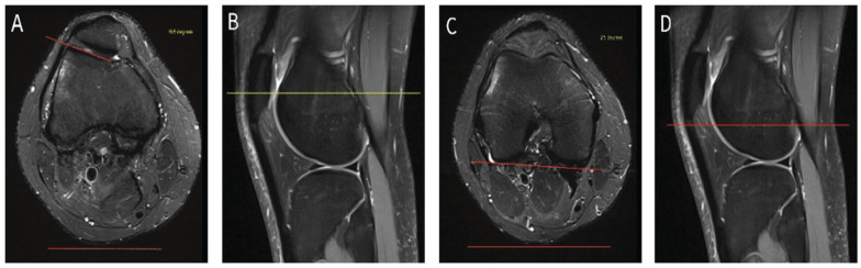 Validity of the 2-Image Lateral Trochlear Inclination to Determine Patellar Instability Due to Trochlear Dysplasia.