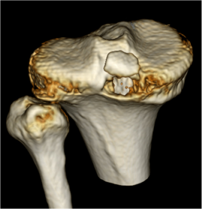 A new CT-based classification system for posterior cruciate ligament tibial avulsion fractures: a nationwide multicenter study.