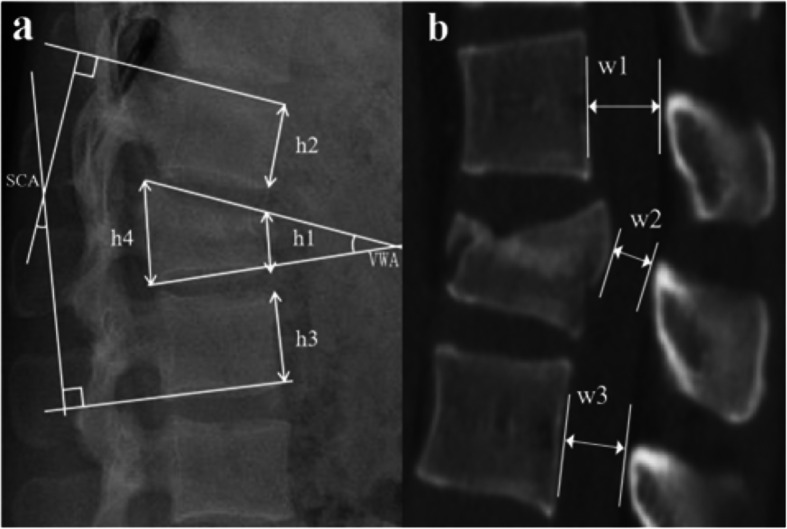 Clinical efficacy and radiological outcomes of a novel screw placement technique for the treatment of traumatic thoracolumbar vertebral fractures under navigation guidance.
