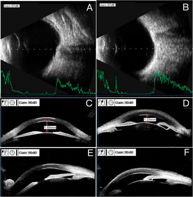 A case of spherophakia-induced angle closure and retinal dysfunction in association with Klinefelter syndrome.