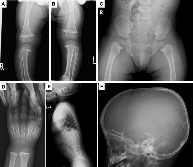 <i>COL10A1</i>-related metaphyseal dysplasia Schmid caused by the p.L644F variant in the <i>COL10A1</i> gene.