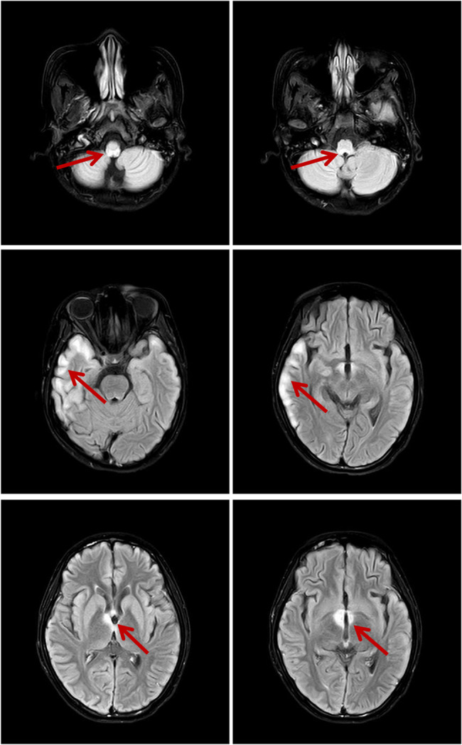 Mycoplasma pneumoniae infection and concurrent aquaporin-4-positive neuromyelitis optica spectrum disorder: a case report and literature review.