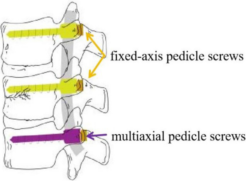 Clinical efficacy and radiological outcomes of a novel screw placement technique for the treatment of traumatic thoracolumbar vertebral fractures under navigation guidance.