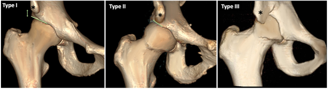 Extra-articular hip impingement: subspine, iliopsoas, and ischiofemoral impingement.