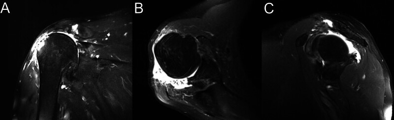 Massive irreparable rotator cuff tear with deltoid tear managed with reverse total shoulder arthroplasty: Case report and review of literature.