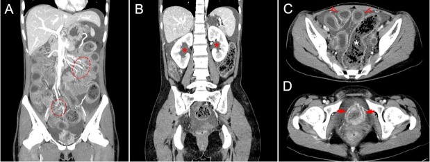 The storm inside: Abdominal and urinary complications in lupus.