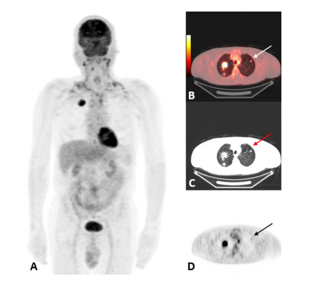 <sup>18</sup>F-FDG PET/CT Parameters and Standard Uptake Values Predicting Contralateral Lung Metastasis in Lung Cancer.