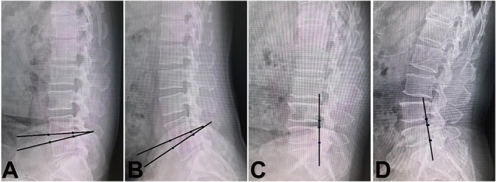 Efficacy and Safety of Unilateral Interlaminar Endoscopic Decompression for Lumbar Spinal Stenosis: A Retrospective Study of 176 Cases With a 3-6 Year Follow-Up.