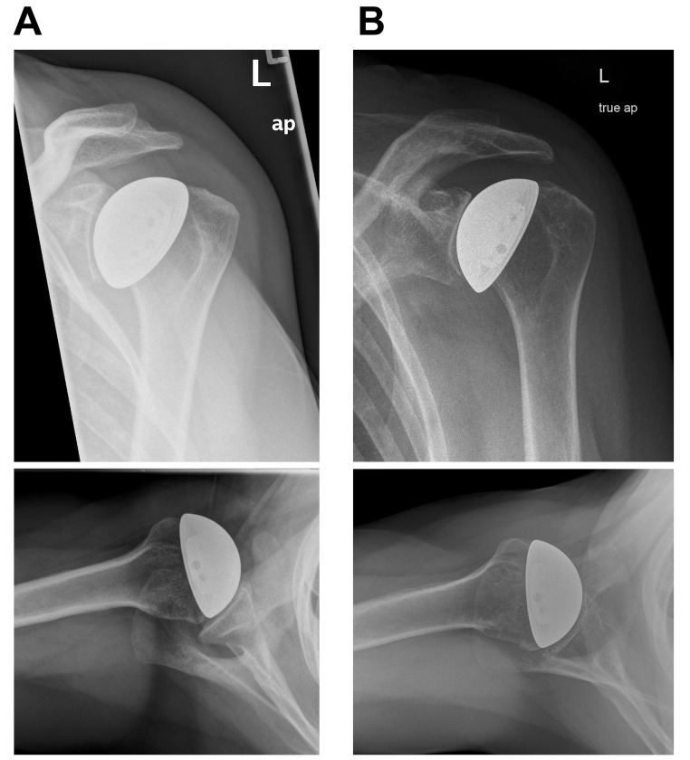 Long-term results of cementless humeral head resurfacing for humeral head osteonecrosis - a monocentric longitudinal observational study.