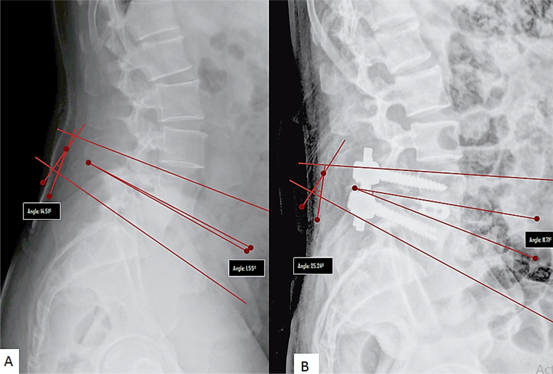 Radiographic and surgical predictive factors for restoring segmental lumbar lordosis and normal spinopelvic balance following TLIF surgery in lumbar spondylolisthesis patients.