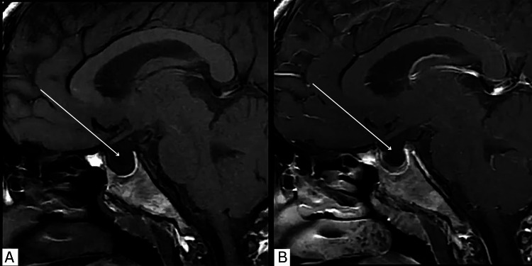 The Role of Exenatide, a Glucagon-Like Peptide-1 (GLP-1) Receptor Agonist, in Idiopathic Intracranial Hypertension and Polycystic Ovary Syndrome: A Case Report.
