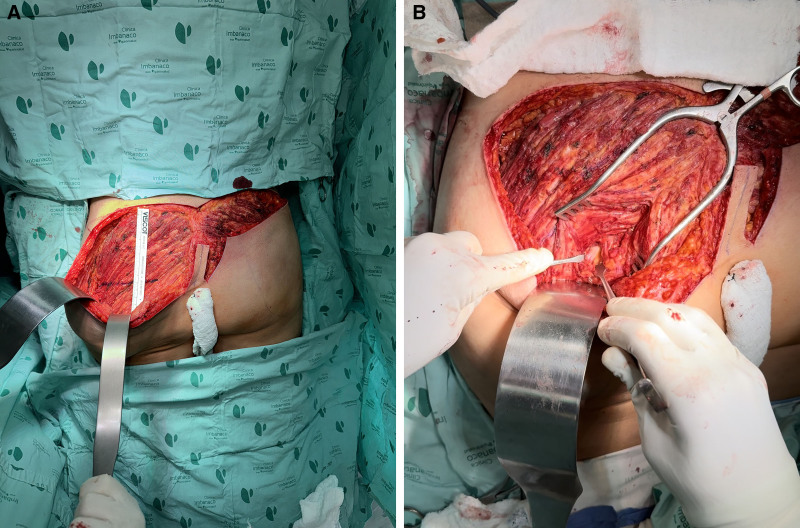 Surgical Approach for Sciatic Nerve Entrapment Secondary to Biopolymer Injection.