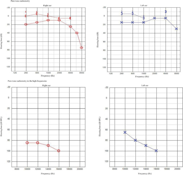 Hearing assesment in children after intrauterine exposure to platinum-based treatment of pregnant cancer patients: A study from the International Network on Cancer, Infertility and Pregnancy.