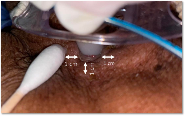 Petroleum jelly vs. Saline in tracheostomy wound care and pressure injury prevention: a randomized controlled trial.