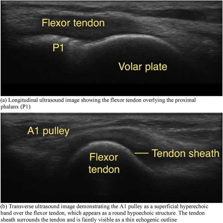 Effect of percutaneous release versus steroid injection among adults with trigger fingers: a randomized clinical trial.