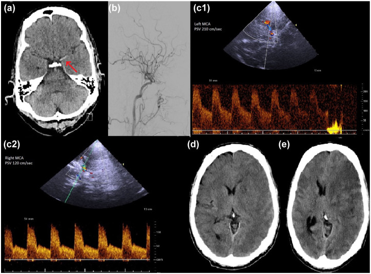Increased middle cerebral artery velocity predicts malignant media infarction after endovascular stroke thrombectomy.