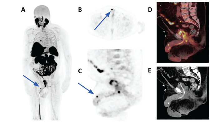 Penile Metastasis from Prostate Cancer: Detection on <sup>18</sup>F-PSMA-1007 PET/CT.