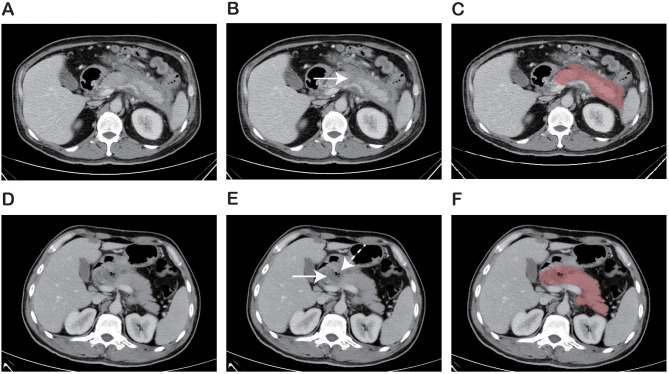 A Nomogram for Early Prediction of Infected Pancreatic Necrosis Based on Contrast-Enhanced CT Radiomics and Inflammatory Indicators.