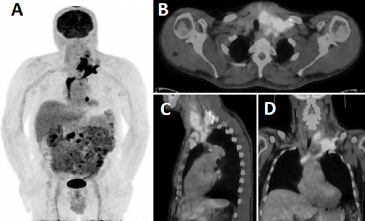 Extensive Malignant Thrombus Revealed by <sup>18</sup>F-FDG PET/CT in Patient with Papillary Thyroid Cancer.