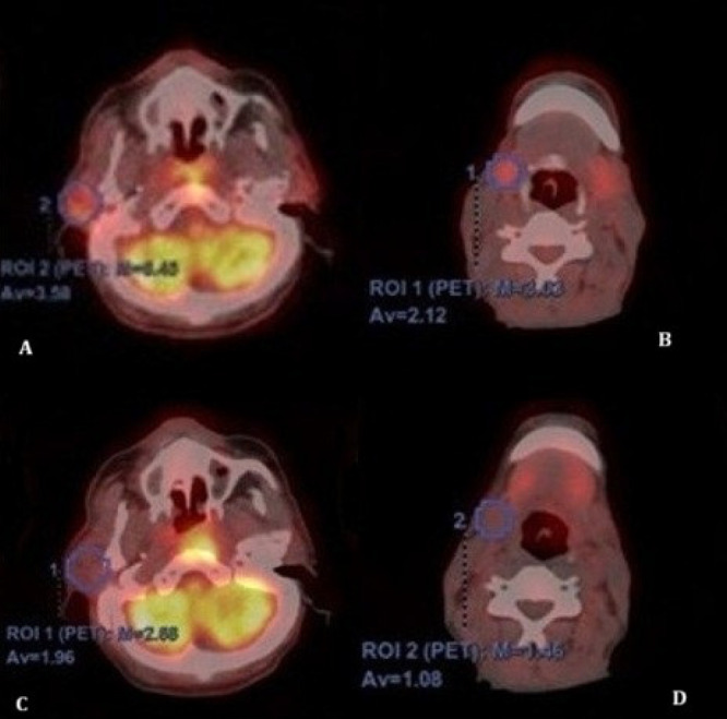 Radiation-induced Xerostomia: Evaluation with <sup>18</sup>F-FDG PET/CT.