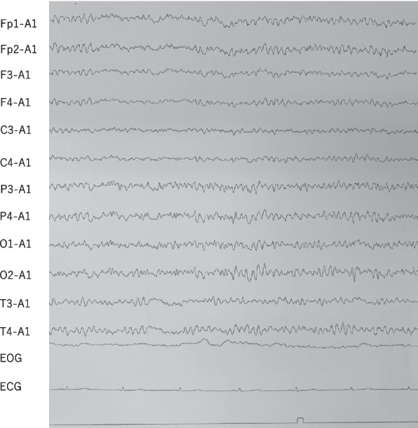 Successful treatment of five cases of catatonia treated with guanfacine without ECT: a case series from a psychiatric hospital in Japan.