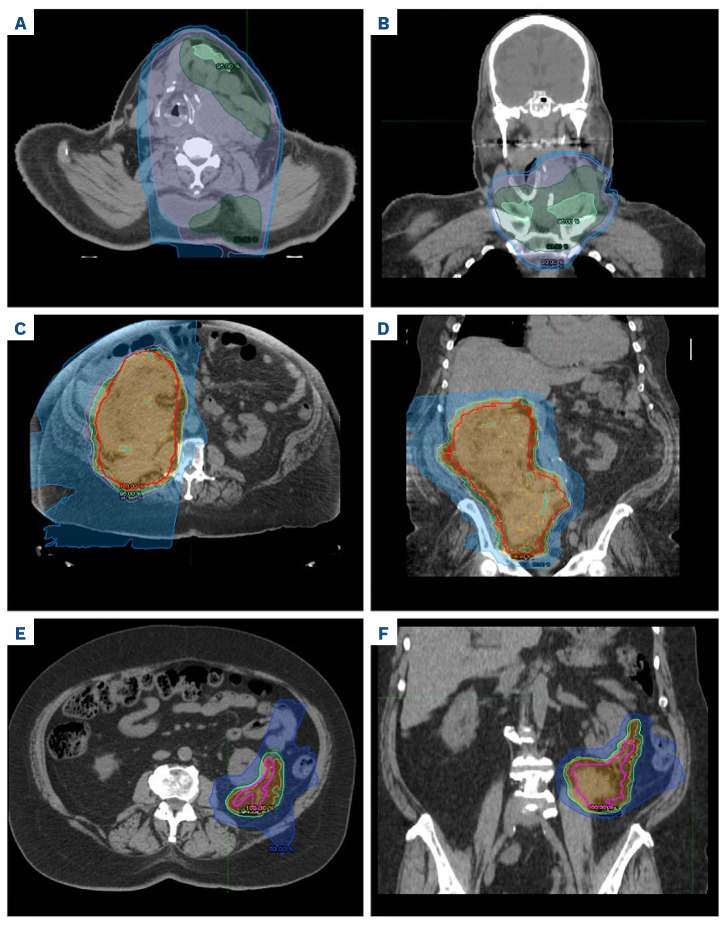 Radiation therapy to manage isolated relapse after chimeric antigen receptor T-cell therapy in multiple myeloma.