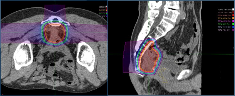Prophylactic intestinal resection following carbon-ion radiotherapy for locally recurrent rectal cancer: a case report.
